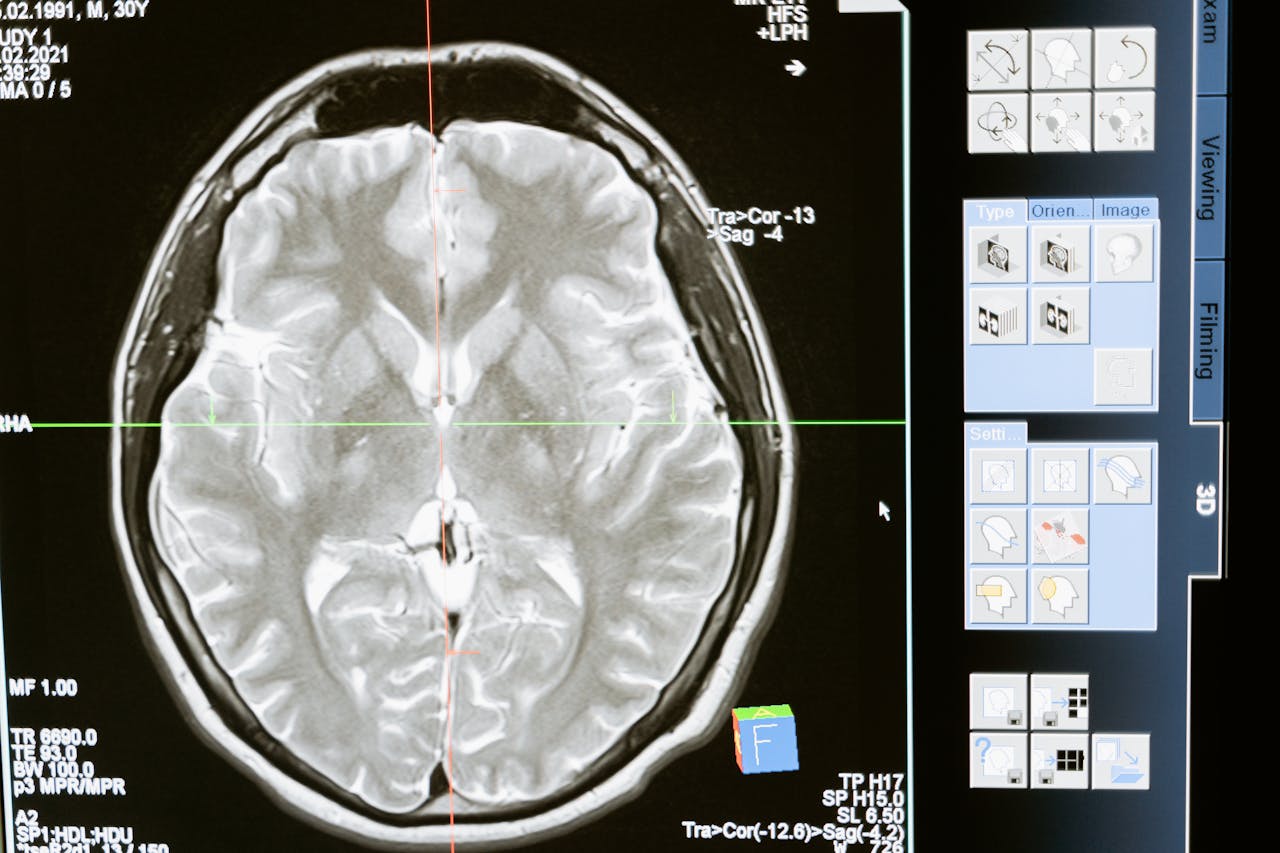 Brain imaging MRI